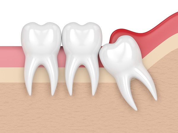 Wisdom Tooth Extraction