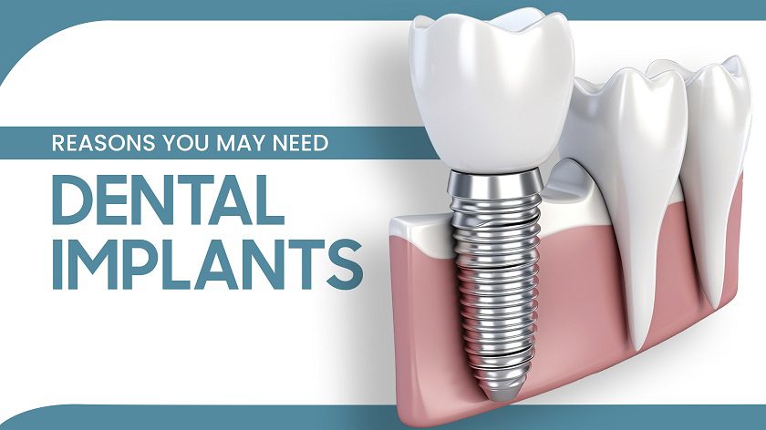 Image of dental implant