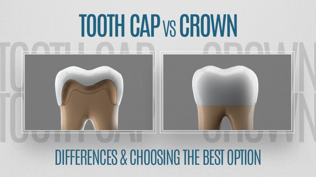 Tooth cap vs crown comparison for dental treatment options