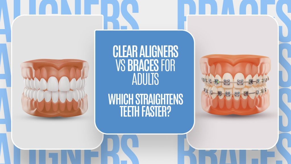 Clear aligners vs braces comparison for faster teeth straightening