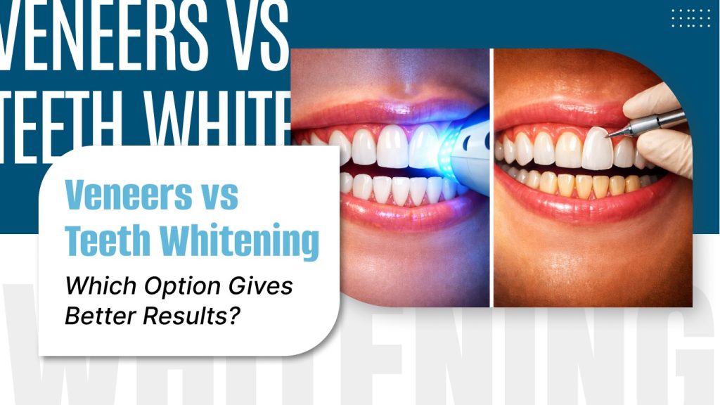 Close-up of teeth showing veneers vs whitening treatment